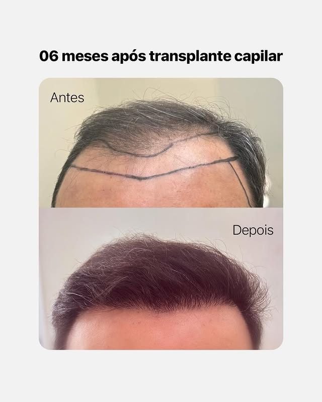 Antes e depois de transplante capilar — correção de entradas, 6 meses