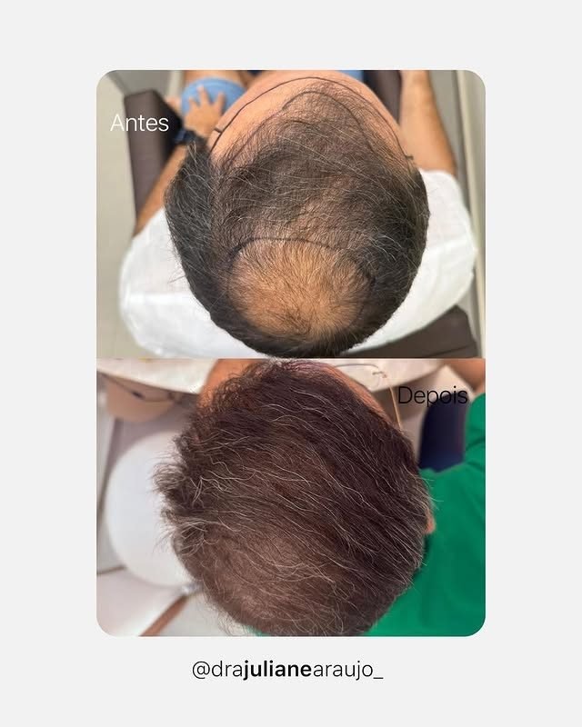 Antes e depois de transplante capilar — cobertura da coroa