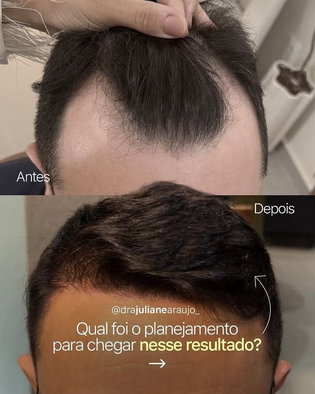 Antes e depois de transplante capilar — nova linha frontal